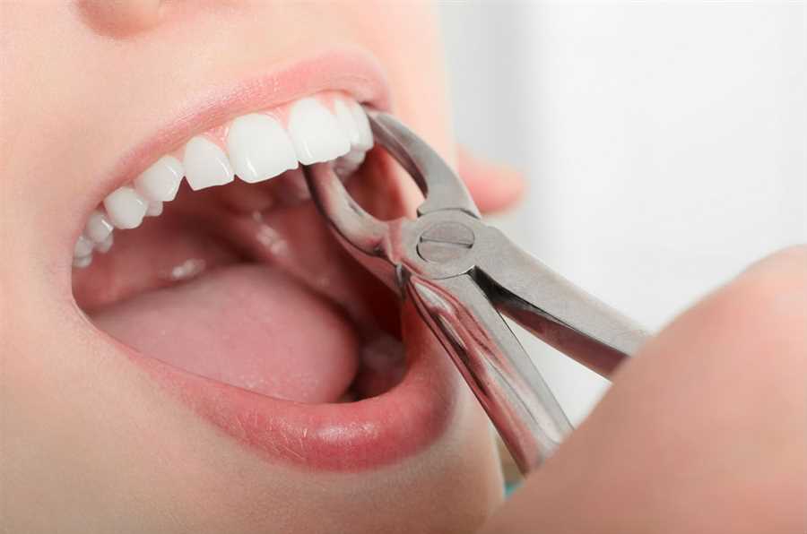 Process for Tooth Extraction and Advice for Aftercare