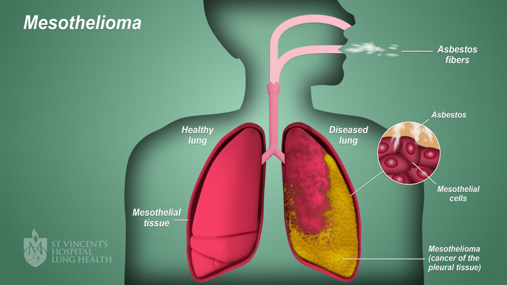 Mesothelioma: A Rare Cancer Caused By Asbestos