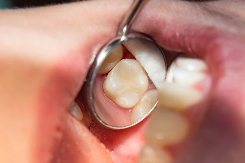 What are the Advantages of Tooth-Colored Fillings?