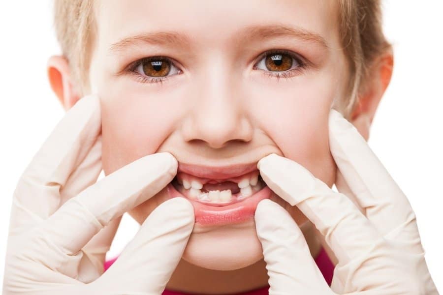 Top Ways Of Tooth Decay Prevention in Kids!