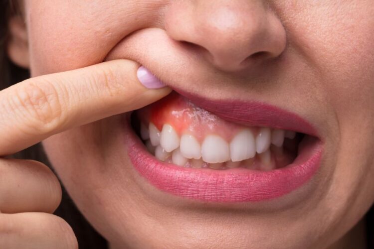 Gum Disease