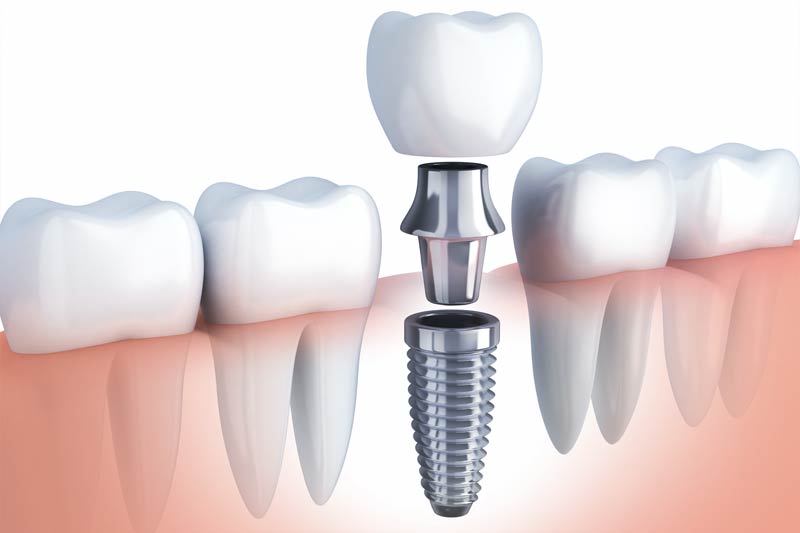 The Benefits of Combining Family Dentistry with Dental Implants