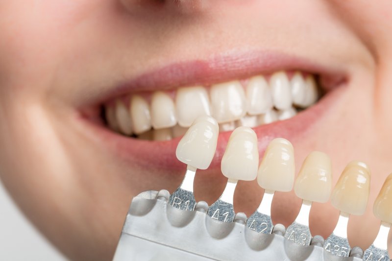 The Process of Getting Porcelain Veneers: Step-by-Step