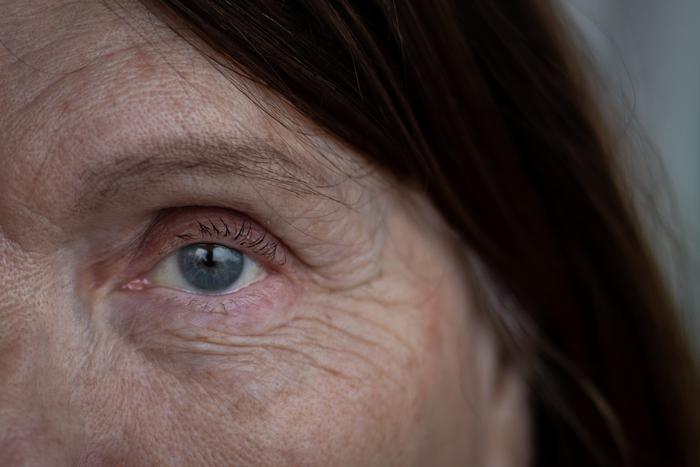 Can Early Treatment Slow Macular Degeneration Progression?