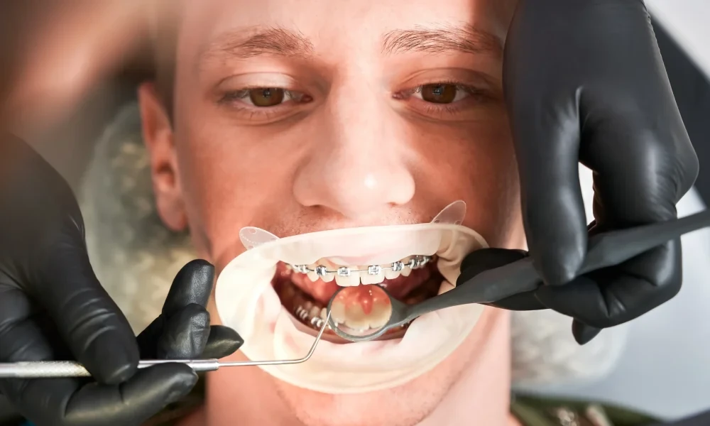 The Role Of Preventive Dentistry In Supporting Implant Longevity