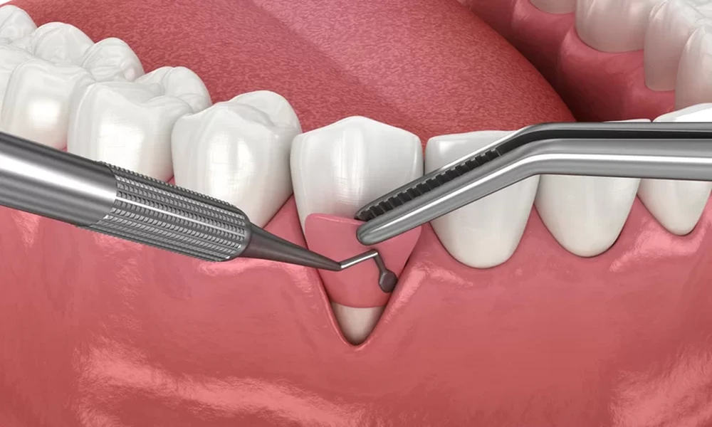 How General Dentistry Tracks And Manages Gum Health Over Time