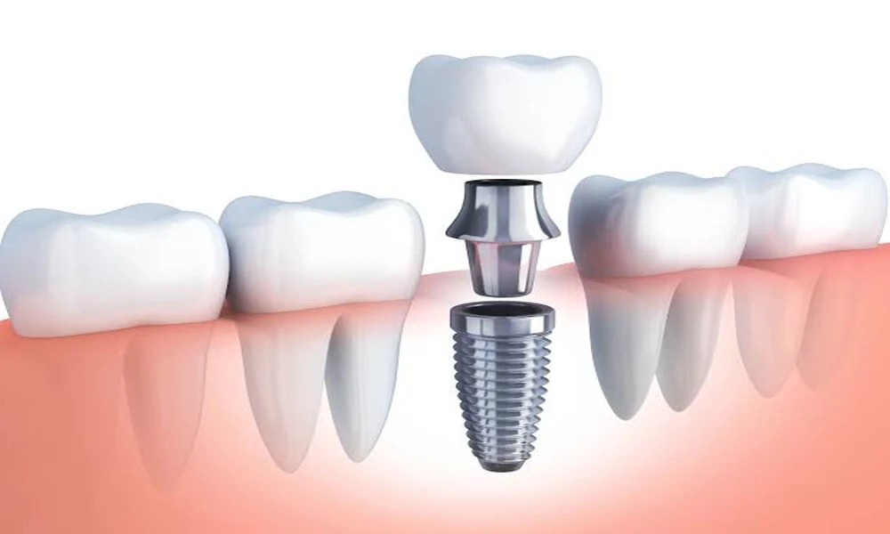 Dental Implant Cost in Mumbai: What Each Component Costs, Why Quotes Differ and What to Ask Before You Pay